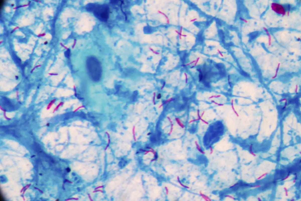 Tüberküloz, öldüren bulaşıcı hastalık, İspanyolca'ya kadar