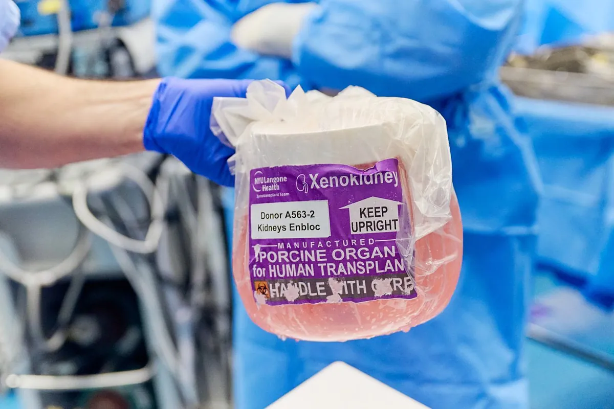 Investigadores chinos realizan el primer xenotrasplante de hígado de cerdo modificado a un paciente con cirrosis avanzada