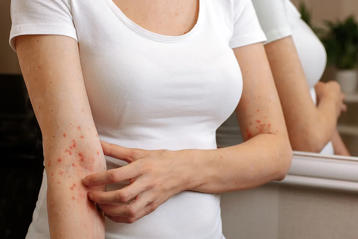 La sarna, la infección de la piel que ha vuelto con fuerza y se ceba con los jóvenes